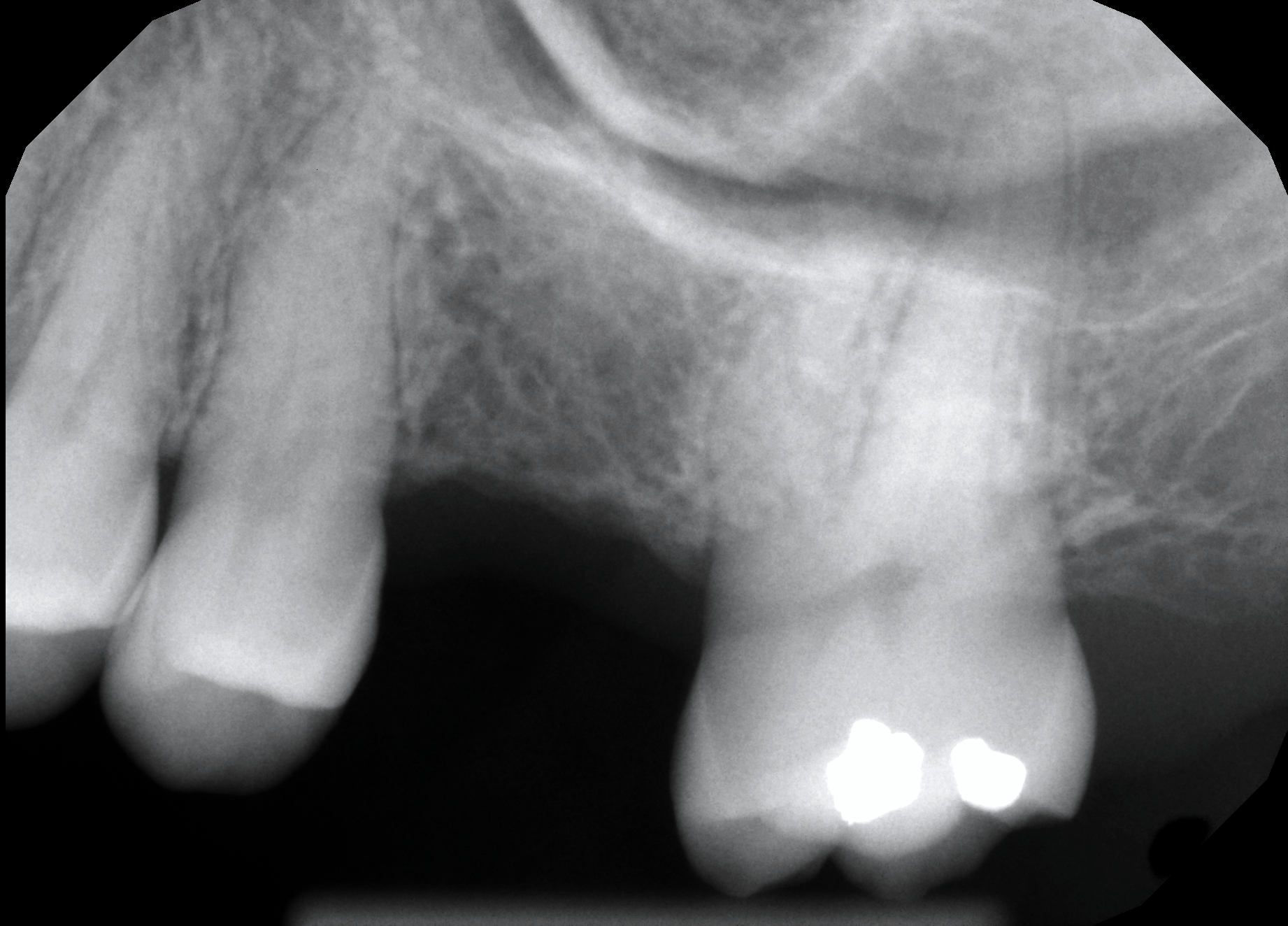 Advantage Dental X-ray Tooth 14